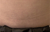 Patient # 41647 After Photo # 2